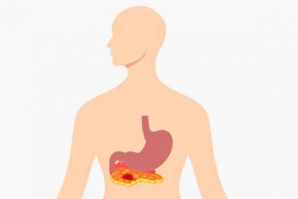 急性胰臟炎「上腹痛」是主要症狀 預防注意3點